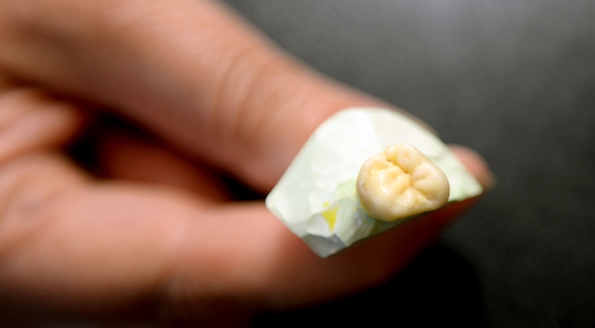Dentist examining a patient's loosened dental crown at Milcovich Dental Arts in Walnut Creek