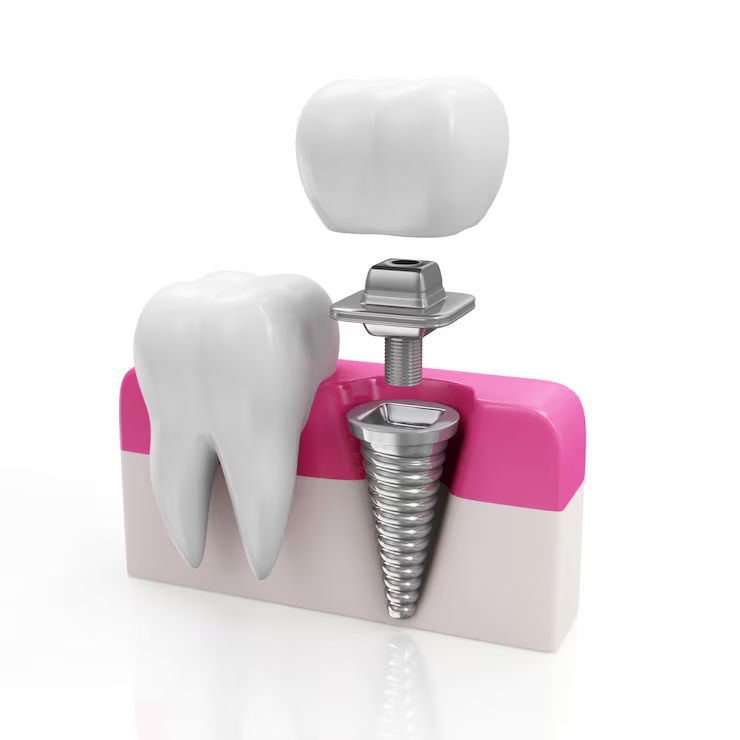 dental implants