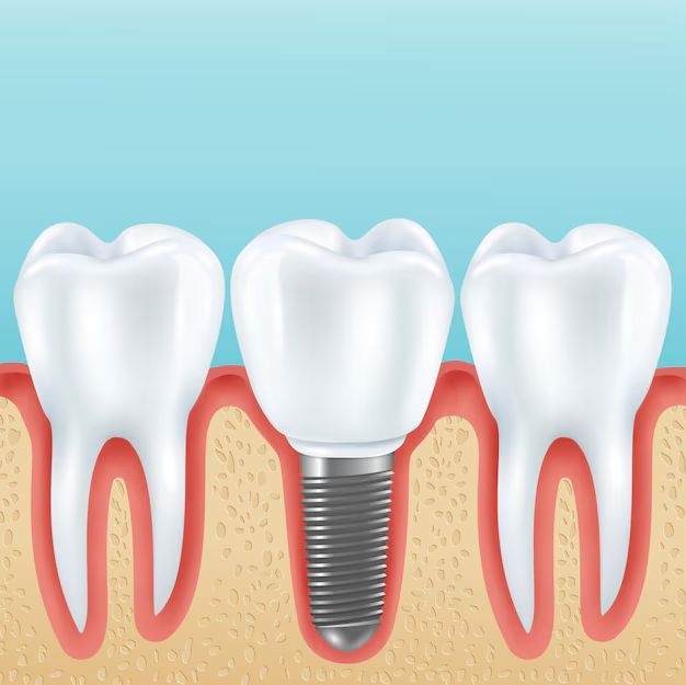 tooth fillings Walnut Creek