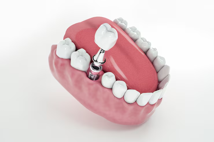 implant treatment
