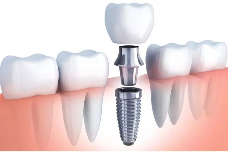 dental implants Walnut Creek