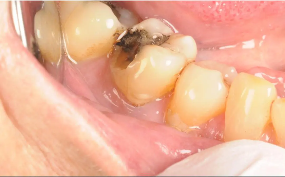 Dentist examining a tooth with a missing filling at Milcovich Dental Arts in Walnut Creek