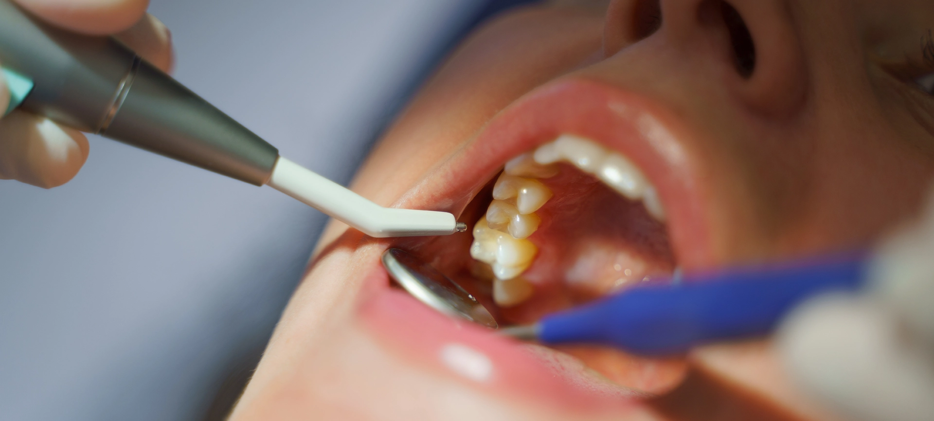 Dentist placing a new dental filling in a patient's tooth