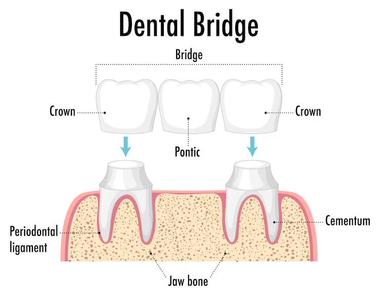 dental crowns in Walnut Creek