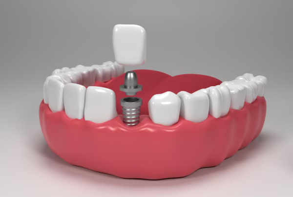 Tooth Replacement