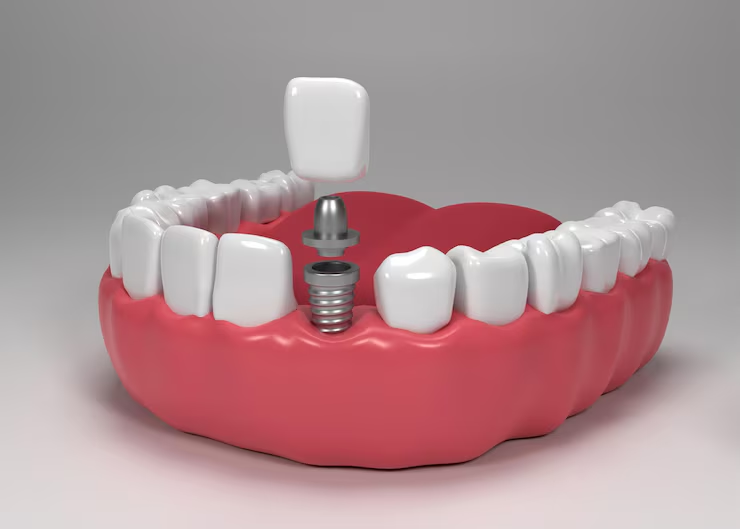 Tooth Replacement