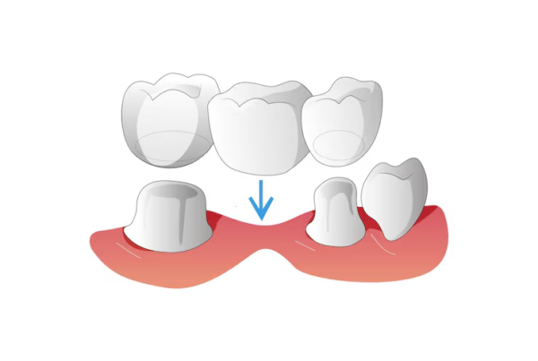 Dental Implants vs. Bridges