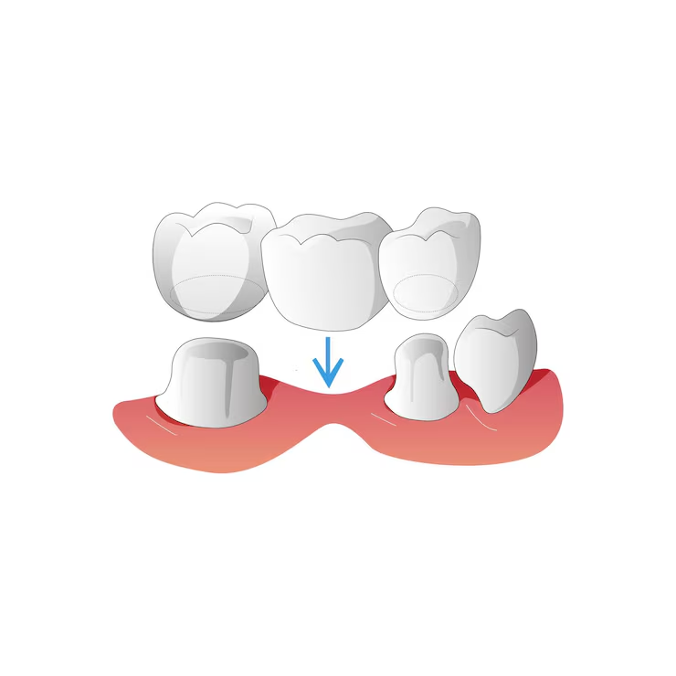 Dental Implants vs. Bridges