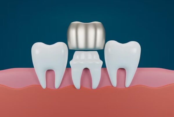 dental crowns in Walnut Creek