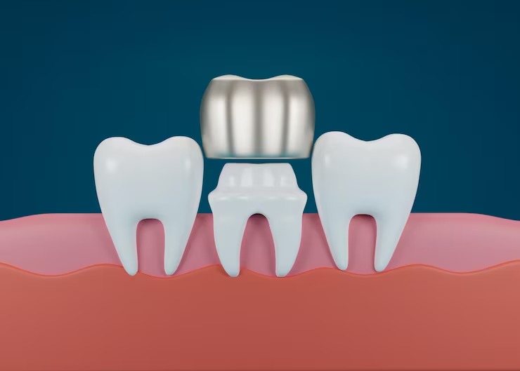 dental crowns in Walnut Creek